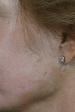 Laser Skin Resurfacing Before and after photo