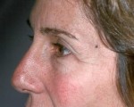 Laser Skin Resurfacing Before and after photo