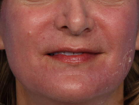 Fraxel® before and after photo