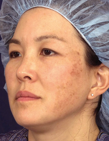 Fraxel® before and after photo