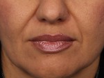 Injectable Fillers Before and after photo