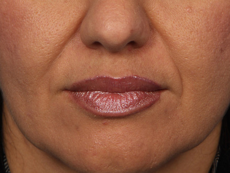 Injectable Fillers before and after photo