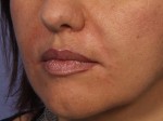 Injectable Fillers Before and after photo