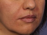 Injectable Fillers Before and after photo