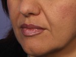 Injectable Fillers Before and after photo