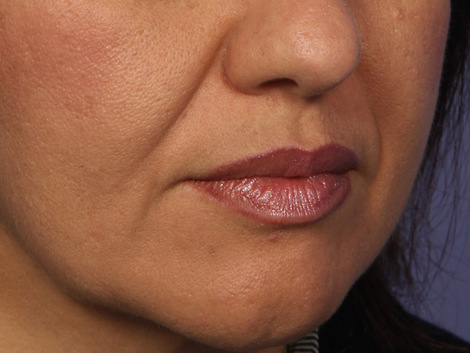 Injectable Fillers before and after photo