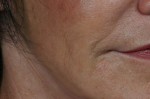 Injectable Fillers Before and after photo