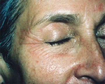 Laser Skin Resurfacing before and after photo