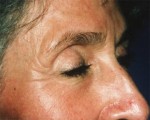 Laser Skin Resurfacing