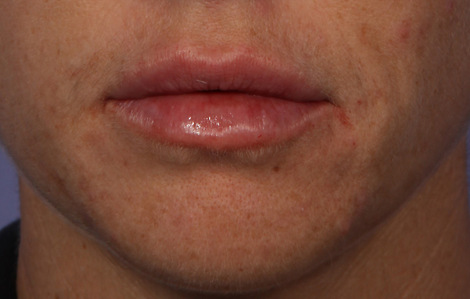 Injectable Fillers before and after photo