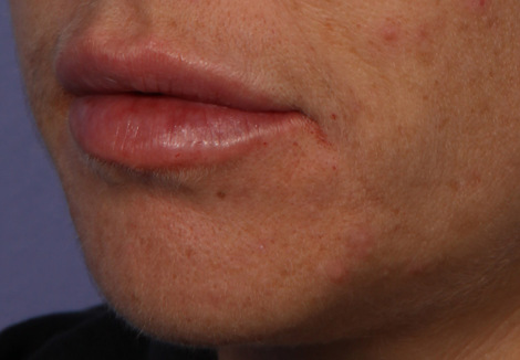 Injectable Fillers before and after photo