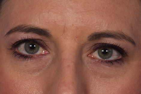 Injectable Fillers before and after photo