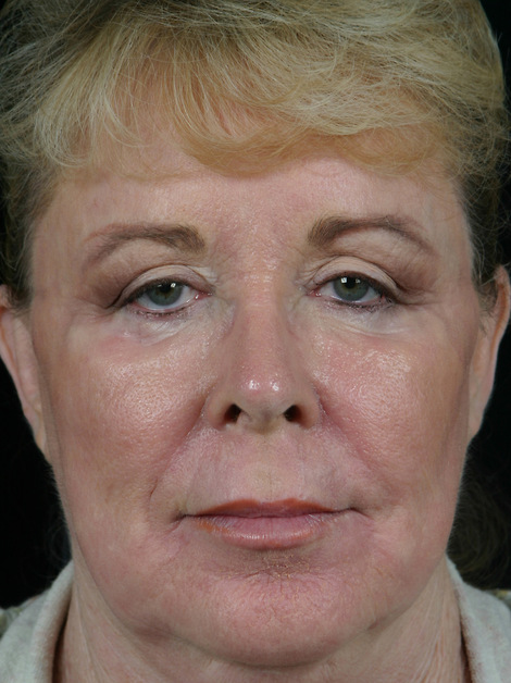 Injectable Fillers before and after photo