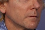 Injectable Fillers Before and after photo