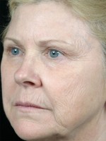 Injectable Fillers Before and after photo