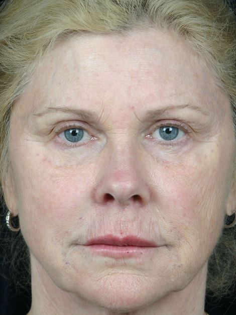 Injectable Fillers before and after photo