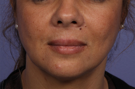 Injectable Fillers before and after photo