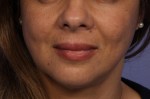 Injectable Fillers Before and after photo