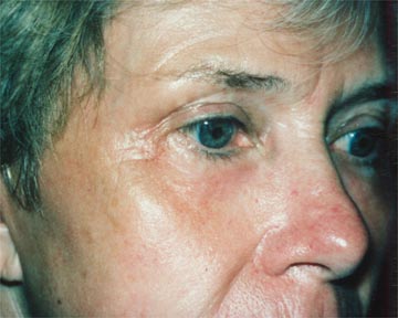 Laser Skin Resurfacing before and after photo