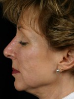 Injectable Fillers Before and after photo