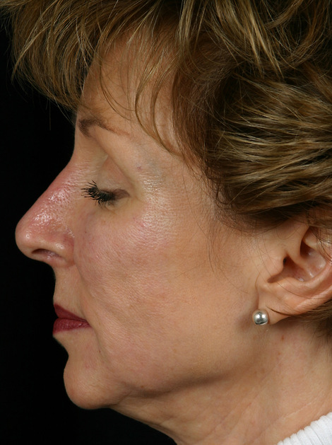 Injectable Fillers before and after photo