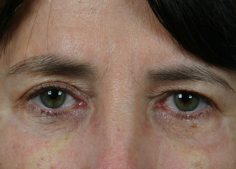 Injectable Fillers before and after photo
