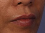 Injectable Fillers Before and after photo