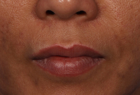 Injectable Fillers before and after photo