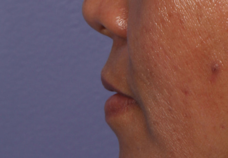 Injectable Fillers before and after photo