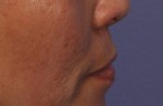 Injectable Fillers Before and after photo