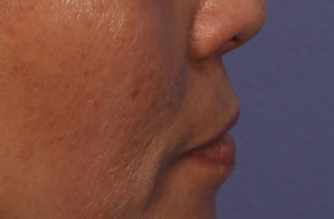 Injectable Fillers before and after photo