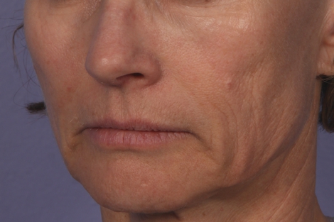 Injectable Fillers before and after photo