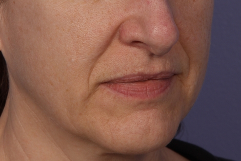 Injectable Fillers before and after photo