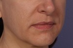 Injectable Fillers Before and after photo