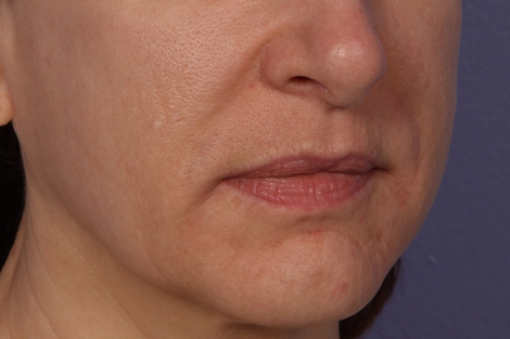 Injectable Fillers before and after photo