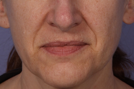 Injectable Fillers before and after photo