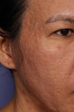 Laser Skin Resurfacing Before and after photo