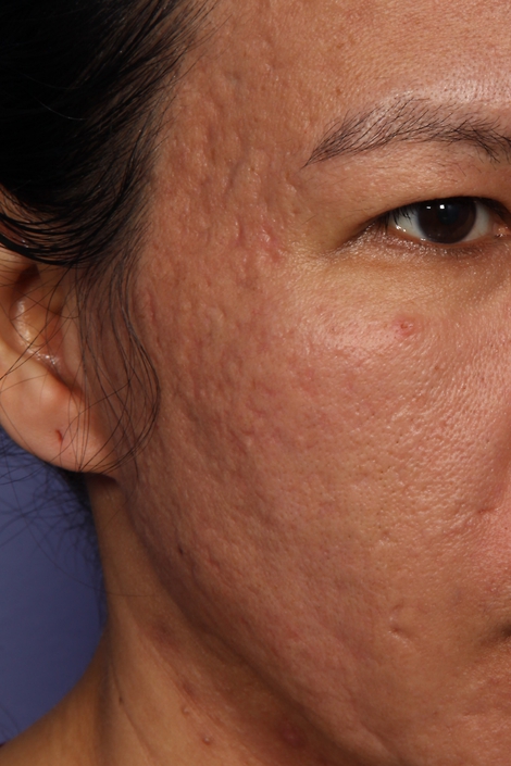 Laser Skin Resurfacing before and after photo