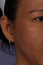 Laser Skin Resurfacing Before and after photo