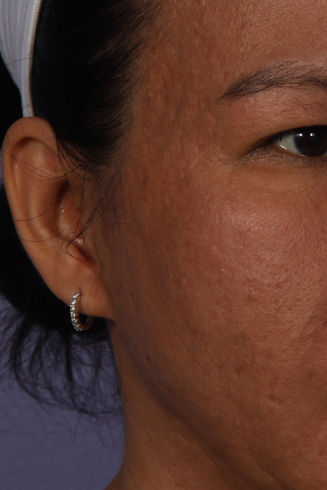 Laser Skin Resurfacing before and after photo