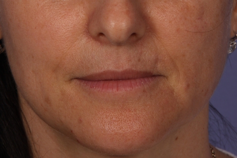 Injectable Fillers before and after photo