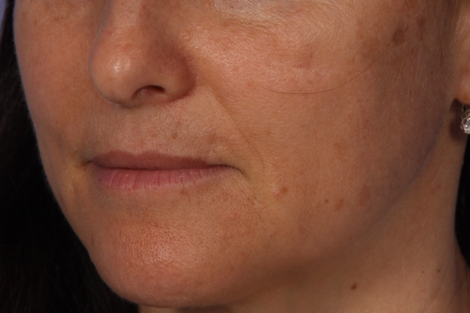 Injectable Fillers before and after photo