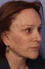 Injectable Fillers Before and after photo