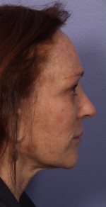 Injectable Fillers Before and after photo