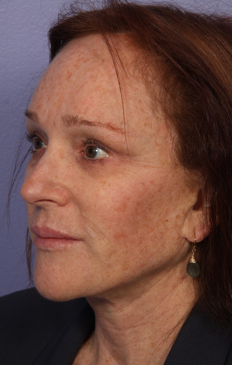 Injectable Fillers before and after photo