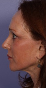 Injectable Fillers Before and after photo