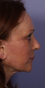 Injectable Fillers Before and after photo