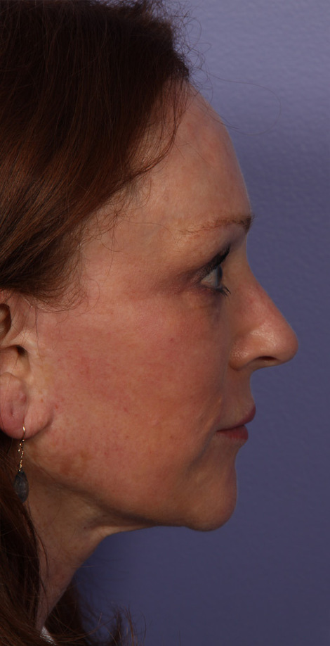 Injectable Fillers before and after photo