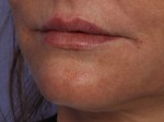 Injectable Fillers