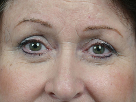 Injectable Fillers before and after photo